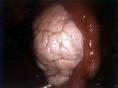 卵巢支持-间质细胞瘤