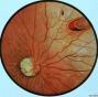 回旋状脉络膜视网膜萎缩