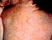 慢性黏膜皮肤念珠菌病