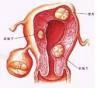 卵巢恶性中胚叶混合瘤