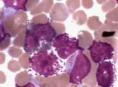 成人型慢性粒细胞白血病