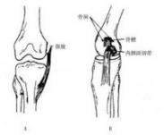膝关节内侧副韧带断裂