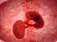 子宫恶性中胚叶混合瘤