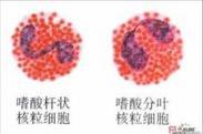 特发性高嗜酸性细胞综合征