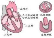 联合瓣膜病变