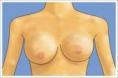 乳房肉瘤