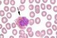 嗜酸细胞增多性复发性肉芽肿皮炎