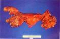 卵巢浆液性肿瘤
