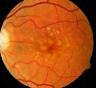 急性视网膜坏死综合征