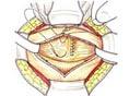 膀胱葡萄状肉瘤