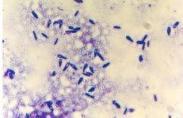 幽门螺杆菌感染