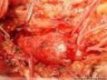 肠系膜动脉瘤
