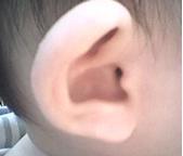 外耳道疖