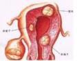 卵巢泡膜细胞瘤