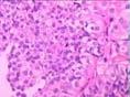 膀胱移行细胞癌
