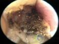 外耳道真菌病