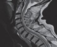 脊髓亚急性联合变性