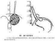 膈下食管憩室