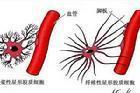 单克隆丙种球蛋白病伴周围神经病