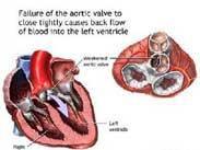 主动脉瓣闭锁不全