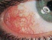 急性虹膜睫状体炎