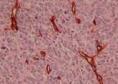 恶性血管内皮细胞瘤