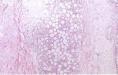 继发性皮肤滤泡中心细胞性淋巴瘤