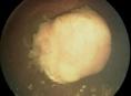 小儿视网膜母细胞瘤