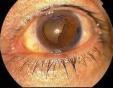 穿透性角膜移植术所致青光眼