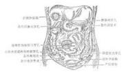 继发性腹膜炎