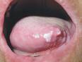 口腔黏膜白斑