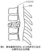 脊柱脊髓伤