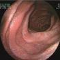 原发性小肠淋巴管扩张症
