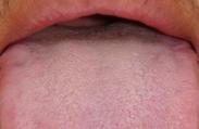 舌甲状腺