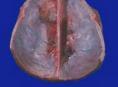 多发性脑膜瘤
