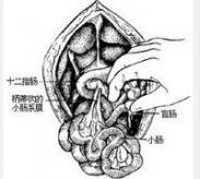 先天性肠旋转异常