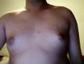 男性乳房肥大症