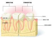 牙周病