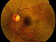 视网膜病变