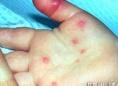 小儿人类疱疹病毒6，7，8型感染性疾病