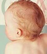小儿不对称身材-矮小-性发育异常综合征