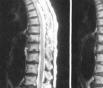 脊髓前综合征