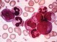 慢性髓细胞白血病