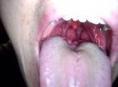 慢性舌扁桃体炎
