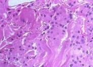 外阴颗粒性肌母细胞瘤