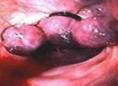 胆石性肠梗阻