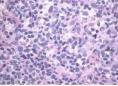 继发性皮肤CD30阳性大细胞淋巴瘤