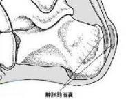 跟腱后滑囊炎