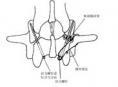 脊椎椎弓峡部裂