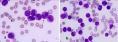 幼年型粒-单核细胞白血病
